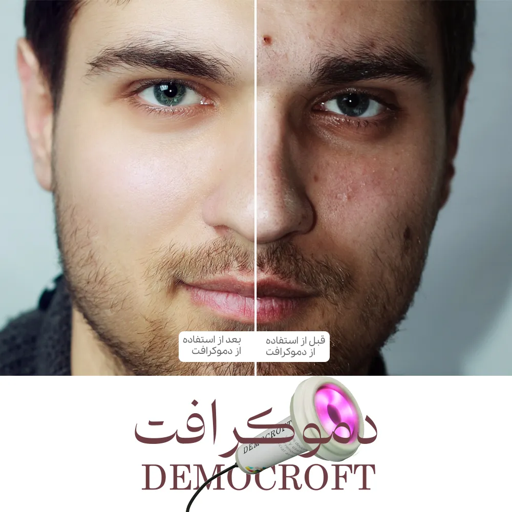 خواص نور درمانی صورت برای درمان جوشهای سر سیاه روی صورت| آگاه طب